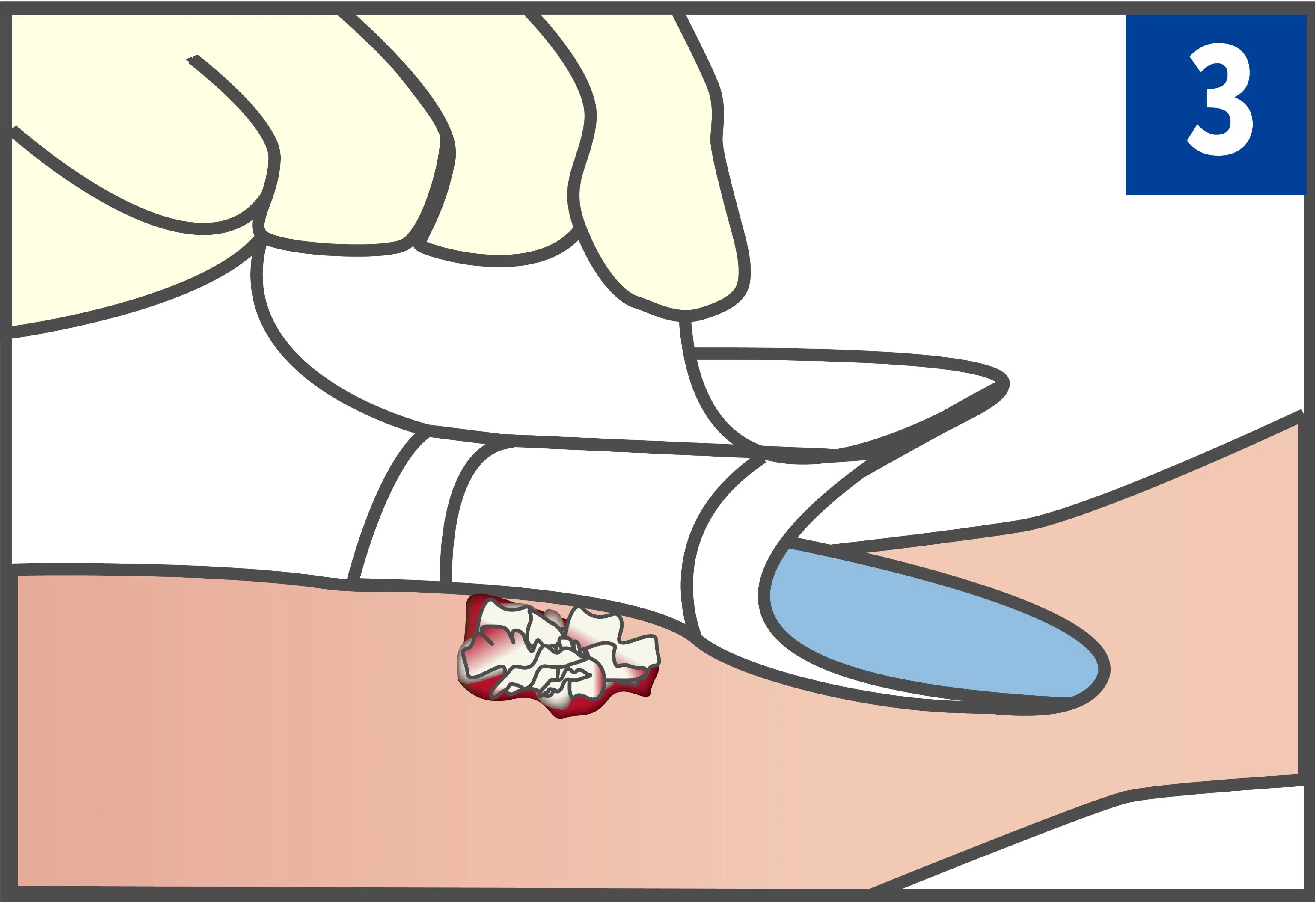 Productos médicos de alto rendimiento Apósito desechable para heridas de alginato para absorber Exudado de la herida