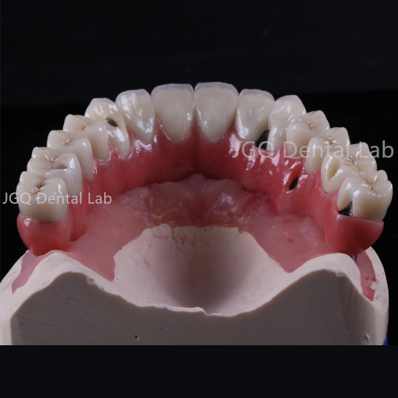 Sastre a mano Puente de Zirconia implante Dental Restauración completa Arco Alto estético