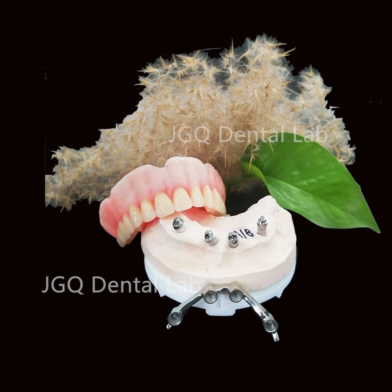 All on 4 Dental Prosthesis Titanium Implant Supported Overdenture Bar