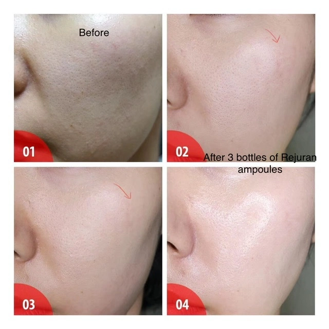 Beauty Salon Home Used Otesaly Wholesale/Supplier Price Skin Whitening Solution Otesaly Mesotherapy Serum for Age Spots Freckles Pigmentation