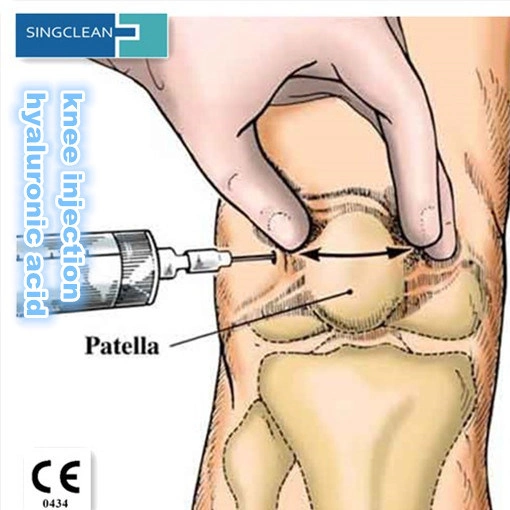 Hangzhou, China materiais suprimentos cirúrgicos hialuronato de sódio Gel Conjunto de infusão