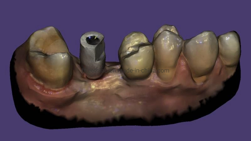 Implant dentaire couronnes en céramique de métal et le pont de la Chine