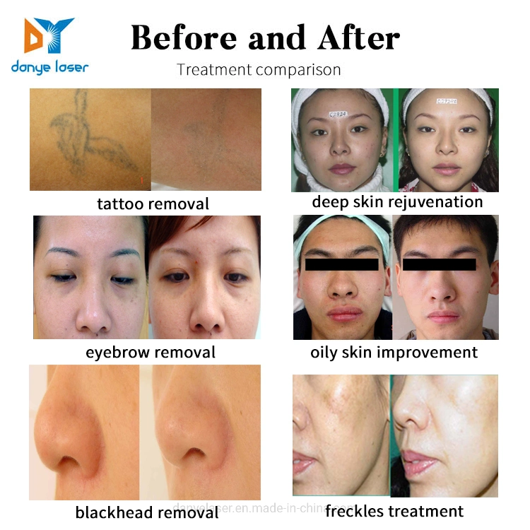 Equipamento de Salão de Beleza da China Remoção de tatuagens tratamento de peeling de carbono ND Laser do interruptor YAG