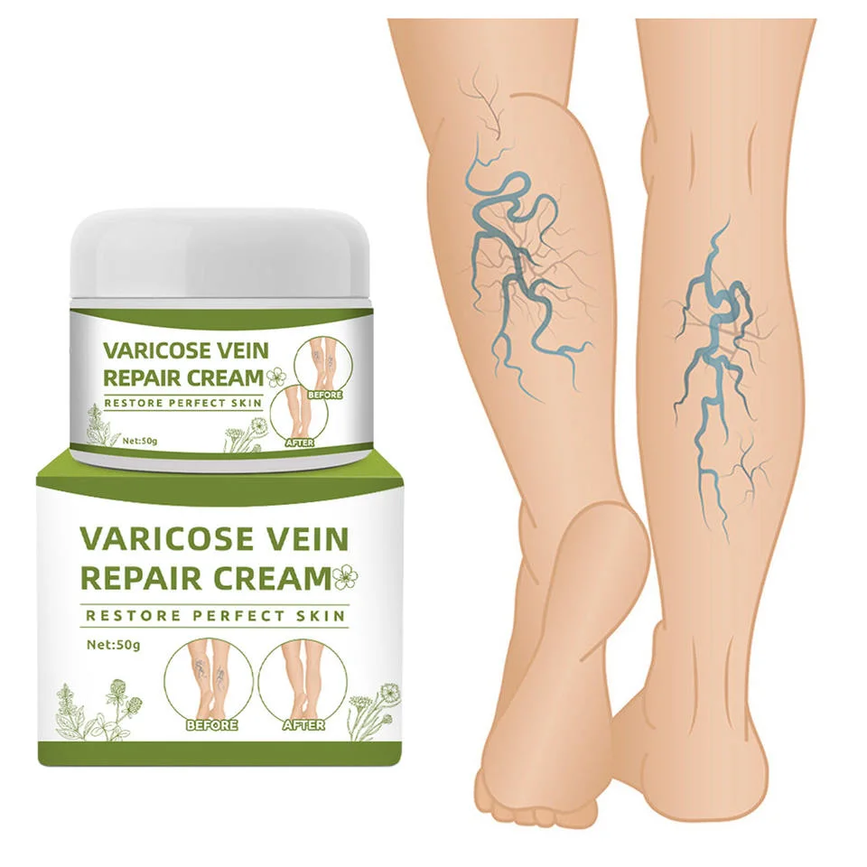 Ingrédients naturels d'onguent vascularite varices de traitement de la Crème de Massage