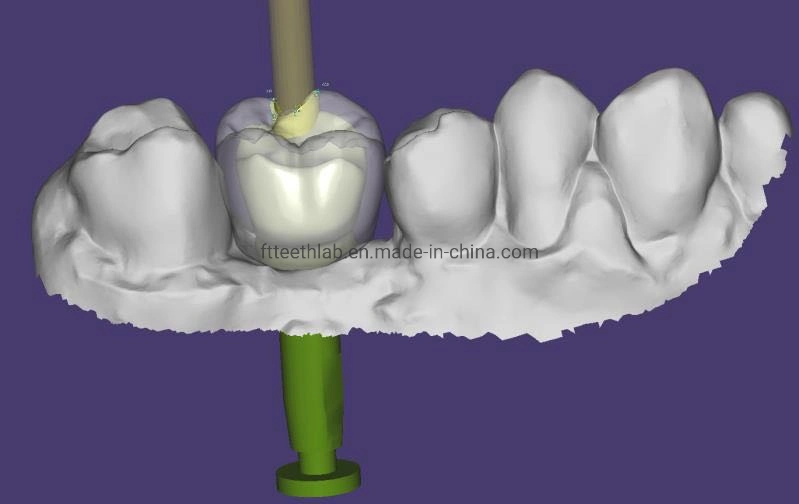 Digitale Implantat-Fälle mit Digital Scan Files Zahnimplantate