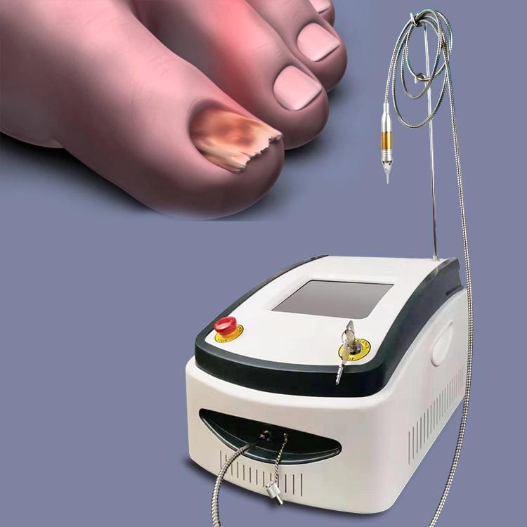 Venta en caliente 2024 dispositivo de tratamiento de uñas fungus 980nm Laser Fungus Tratamiento para la Onichomycosis por uña micótica