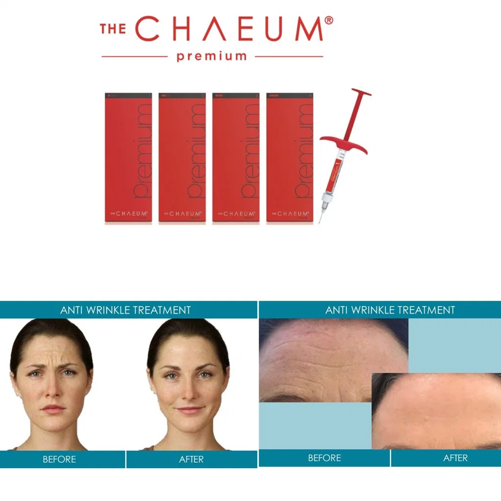 كوريا تزود 2 مل Chaeum Hyaluronic حمض الحشو Yvoire Dermalax NeurMوأماميس Rejeunesse Replengen Bellast Elasty Bonetta Stylage Juvedermrm relleno Dermico