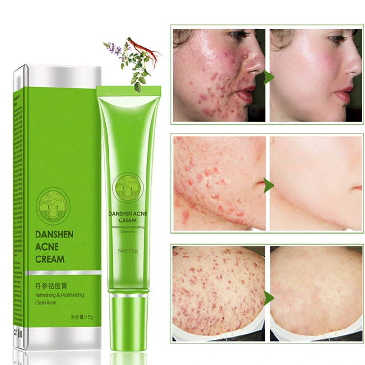 Private Label Acne Cream Moisturizing Soothing Muscles Improves Skin Care