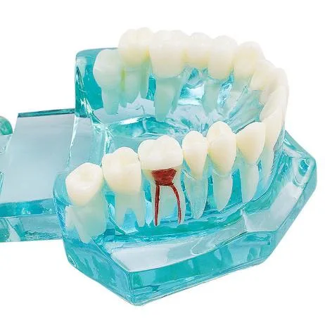 Dental Study Tooth Model Adult Pathological Teaching Teeth Model New Denshine