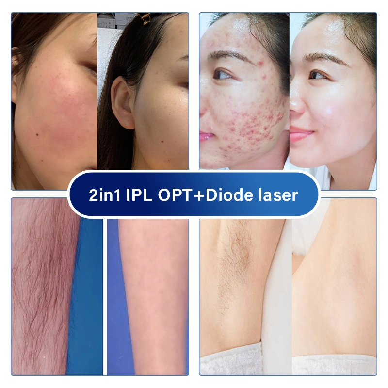 2 en 1 3 Diodo de eliminación de vello de longitud de onda IPL OPT piel Rejuvenecimiento máquina de tratamiento de la pigmentación del acné