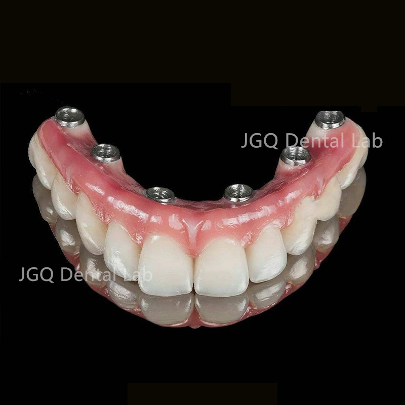 High Precise Dental Implant Tooth Full Ceramic Bridge with Pure Titanium Abutment