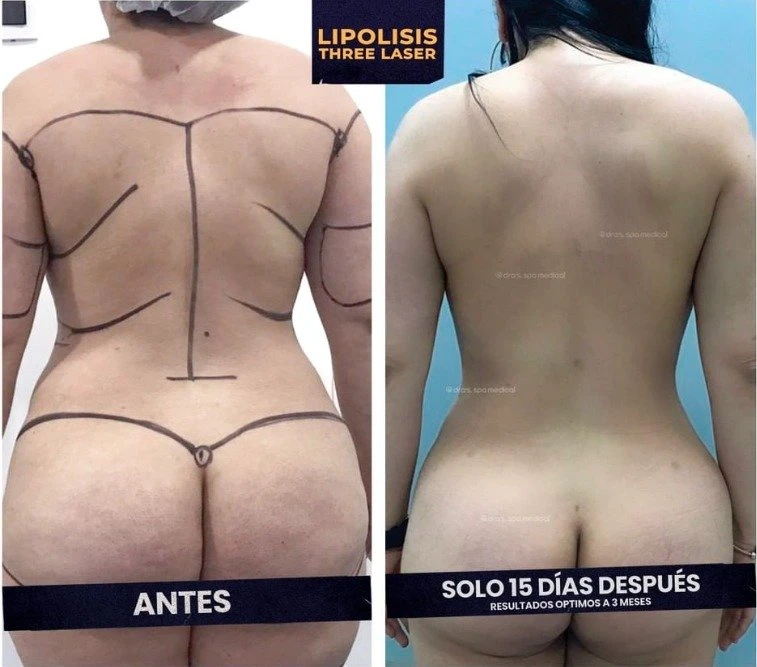 Triangelaser 980nm Endoskin Fibra láser Liposis cara Lipólisis máquina de belleza