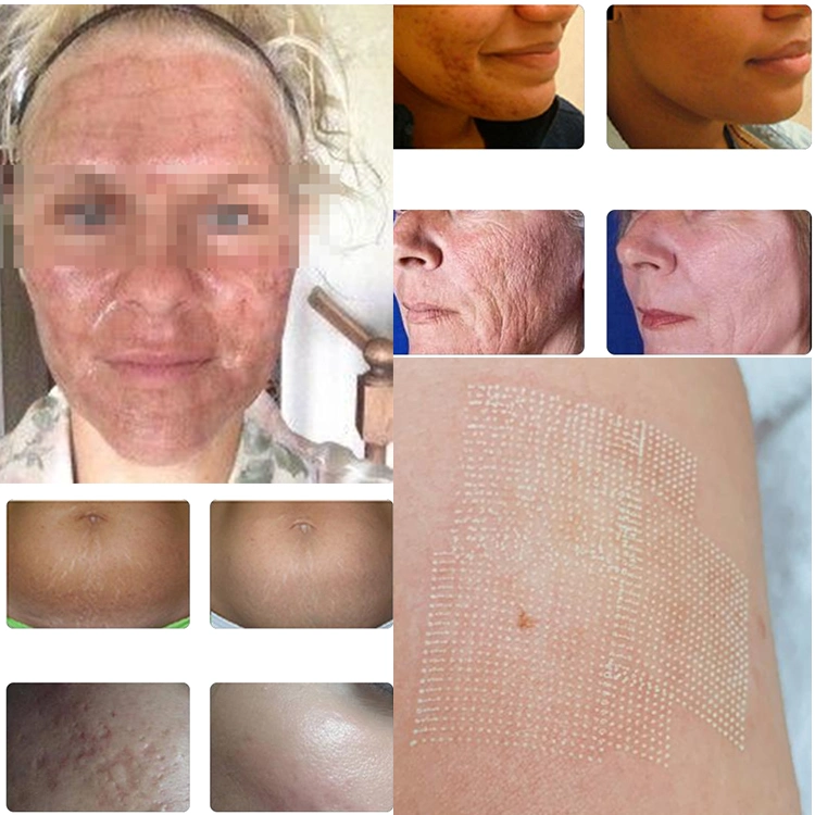 Winkonlaser متجر جديد المنتج النهائي عالية CO2 Fractional Skin ResurFacing معدات الليزر الجميلة/آلة شد المهبل