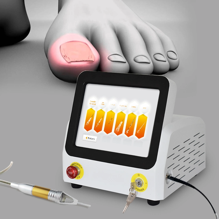 980nm Diode Laser for Portable Nail Fungus Onychomycosi Most Effective Podiatry Equipment