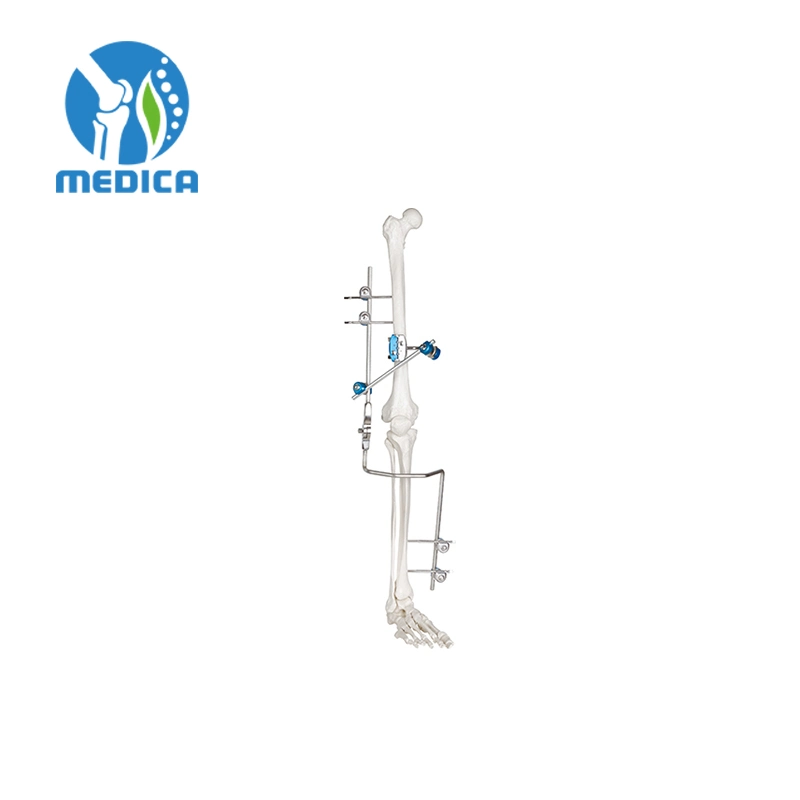 Orthopedic Fracture Combinational External Fixation System Knee Joint Fixator