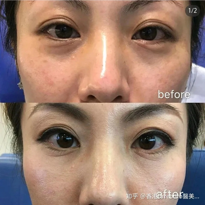 Royal 5 Injectable Teosyal Redensity 2 Puresense (2X1ml) Teoxane Under Eye Circle Filler Dermal Filler Remove Bags Under The Eyes and Dark Circles