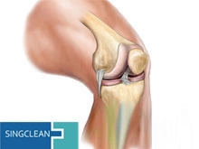 1 Year 1.0%, 1.2%, 2.0% Quickclean 3.0ml, 20mg/Ml Osteoarthritis Knee Injection