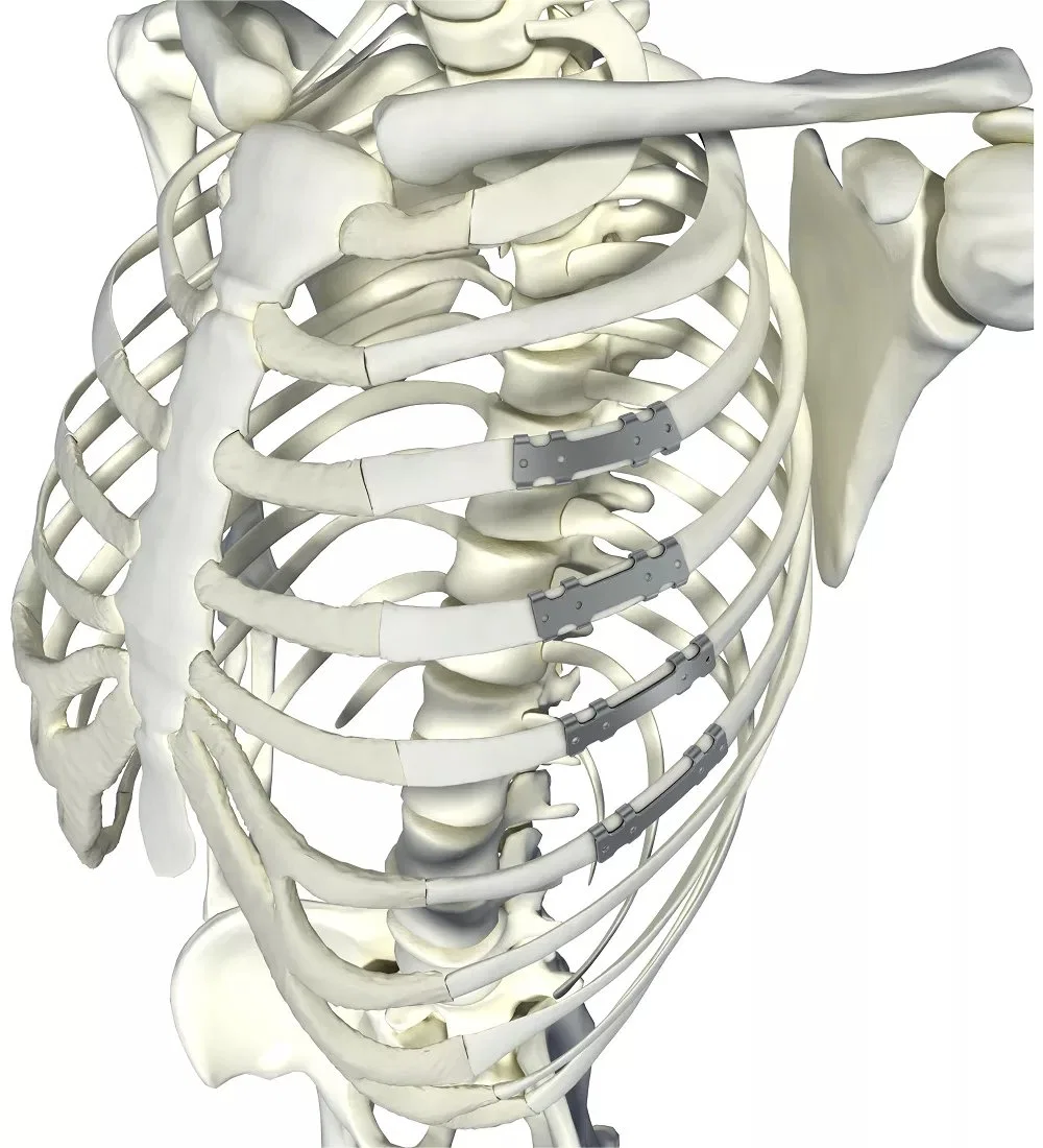 Titanio puro paquete estéril costilla operación quirúrgica de implantes ortopédicos placa Rib