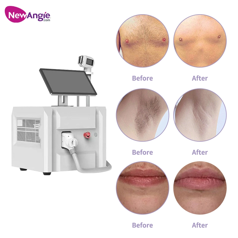 Upperlips Upper Lip Hair Underarm Under Legs Remover Diode Laser Machine