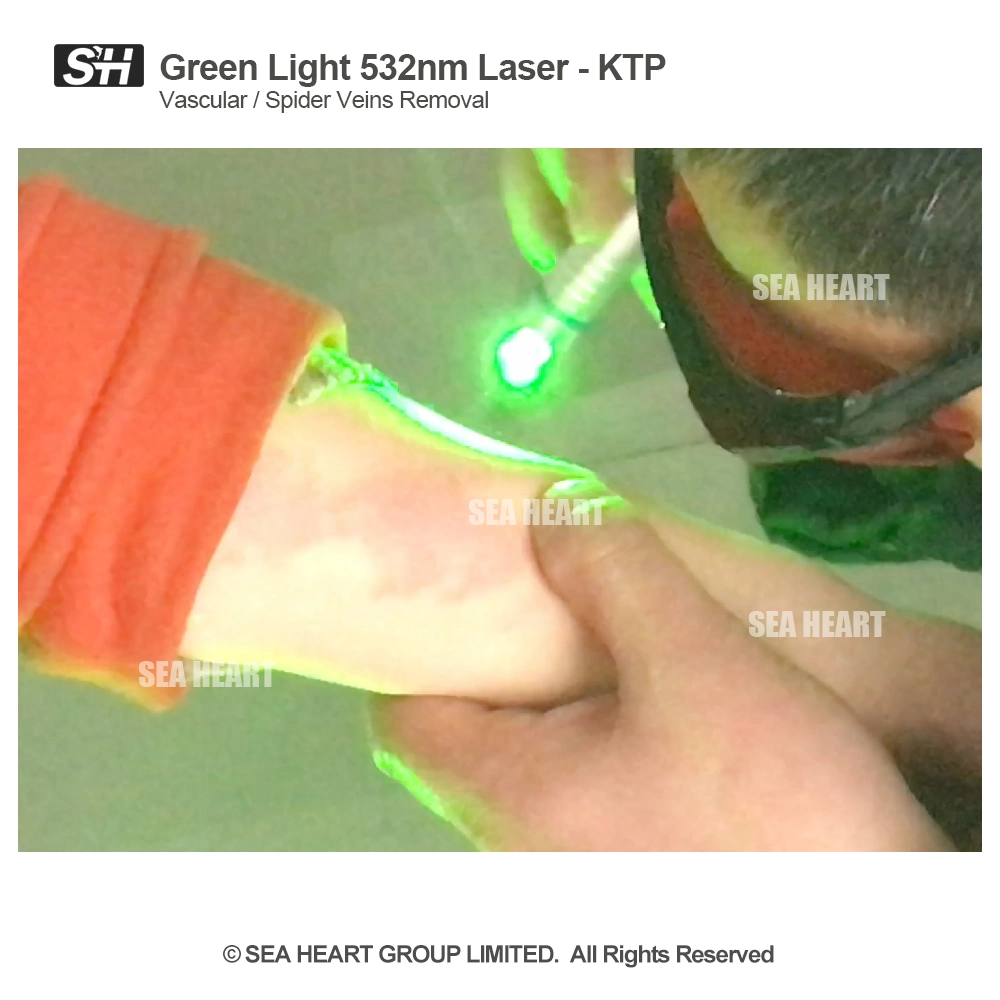 Green Light 532nm Laser for Vascular / Spider Veins Removal