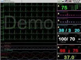 Medical Tragbare 15 Zoll Touchscreen-LCD-Display Multi-Parameter-Patient Überwachen