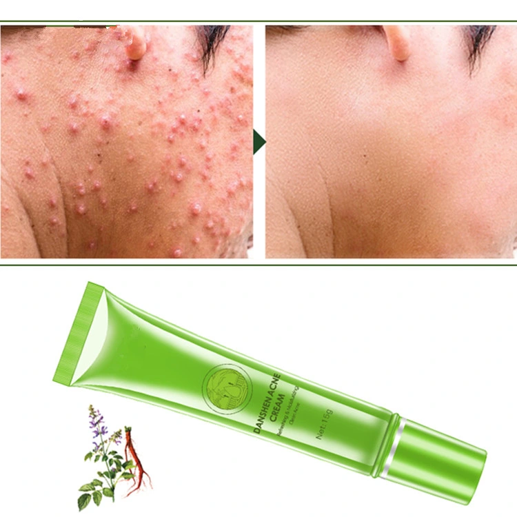 كريم Acne Moisturizing تساعد العضلات المهدئة على تحسين العناية بالبشرة