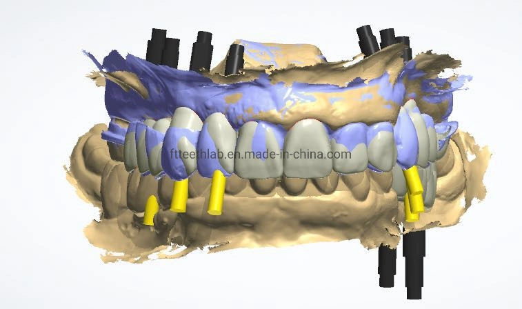 O zircão estética todas na ponte de Implantes Dentários 4 Implantes Dentários