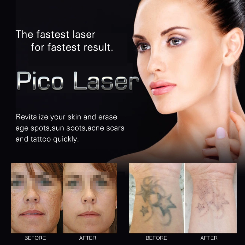 Carbon Laser Peel Whitening Face ND YAG Lasermaschine für Schönheitspflege