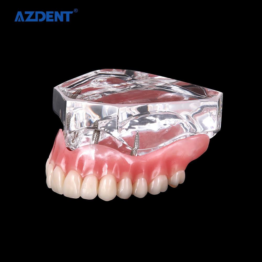 High quality/High cost performance CE Certified Standard Plastic Dental Implant Teeth Model