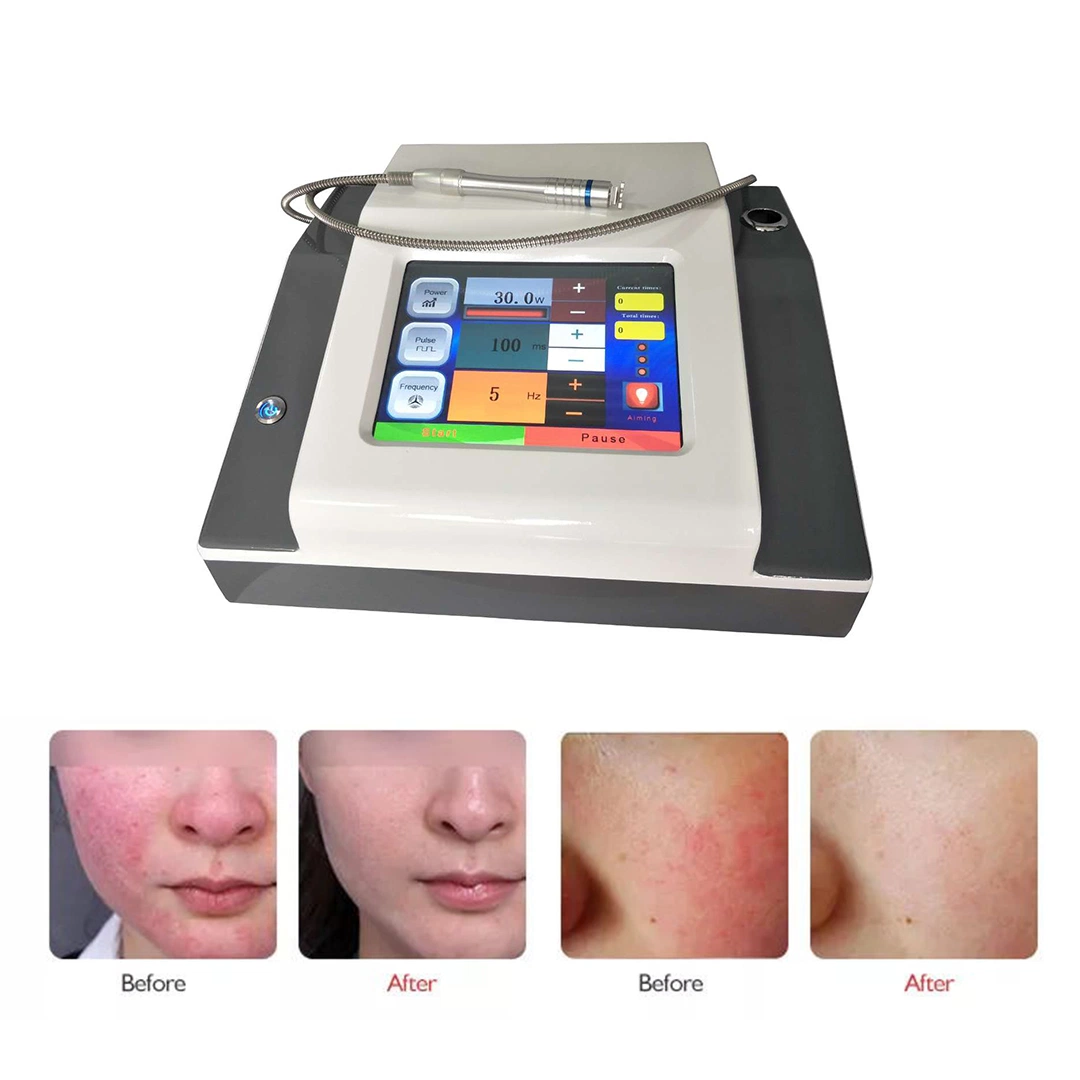 Laser Diode 980nm Laser Vascular Removal for Aesthetic Center Use