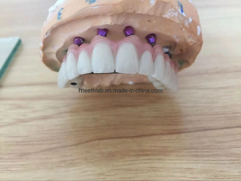 Le contour complet monolithique de zircone Pont de l'implant Implant dentaire