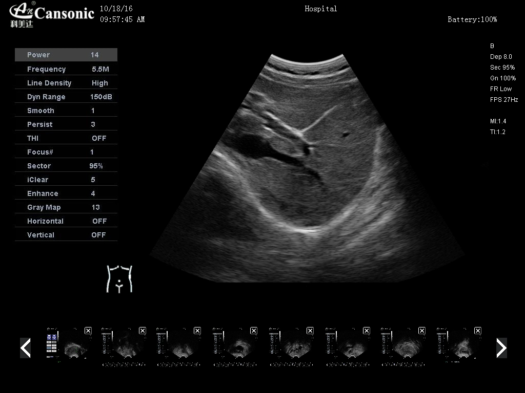 Portable Color Doppler Ultrasound Scanner for Cardiology