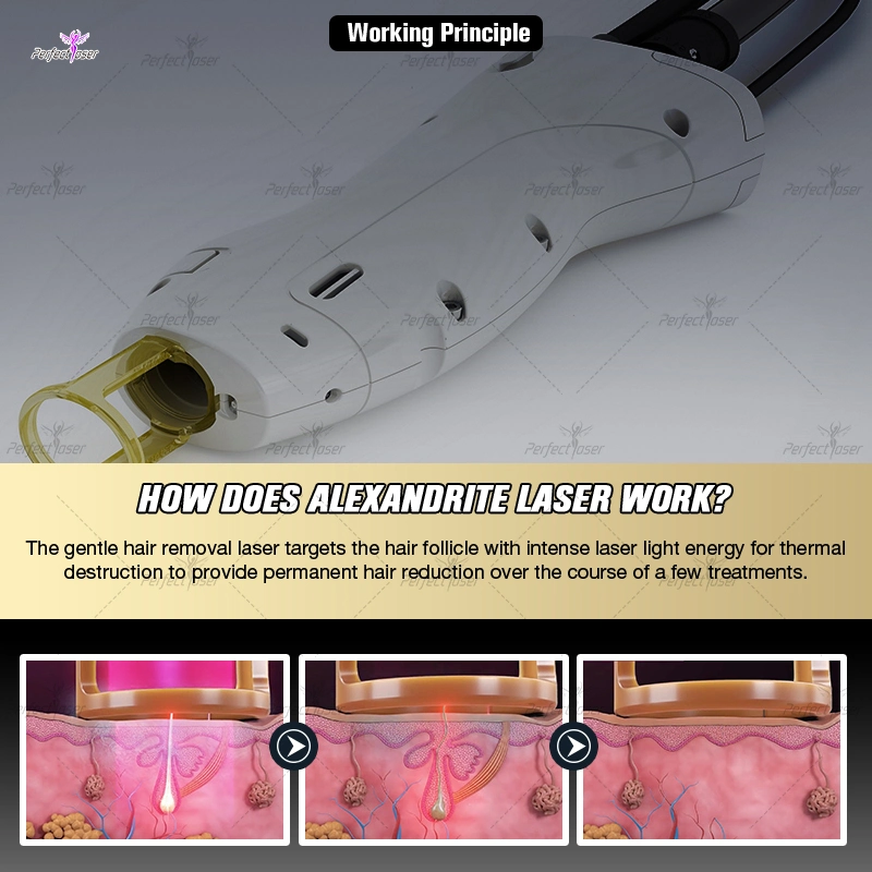 OEM Alexandrite Laser Gental Hair Removal ND YAG PRO 755 1064 Xenon Lamp Long Pulse Machine for All Skin Hair Types