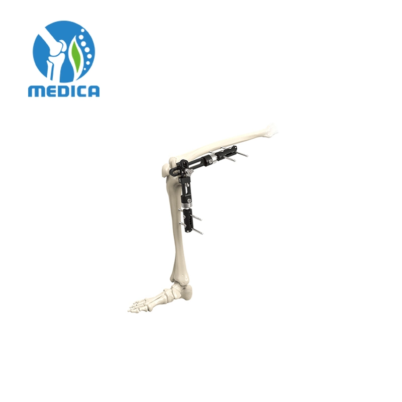 Trauma Orthopedic Single-Sided Integrated Joint External Fixation Elbow Joint External Fixator