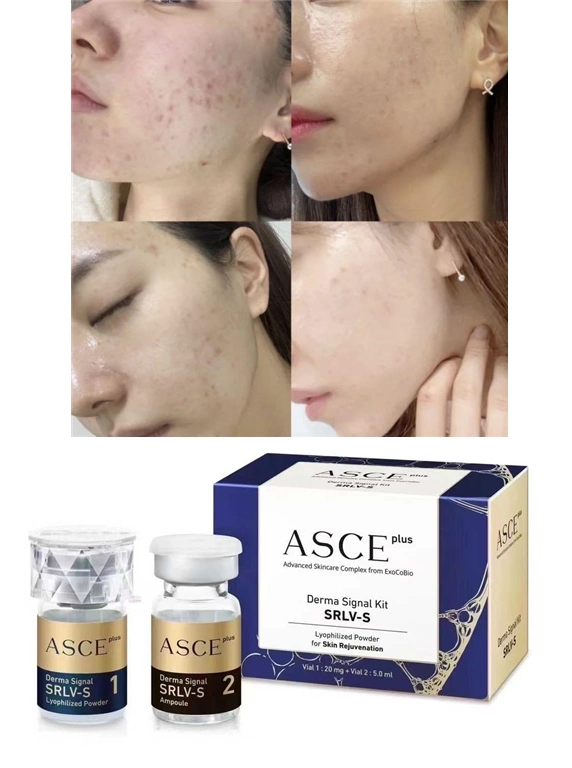 Korea Asce Plus Brighten Skin Cell Regeneration Anti-Aging Asce Plus Derma Signal Kit Srlv-S Lyophilized Powder Acne Exosome Solution Repair Mesotherapy