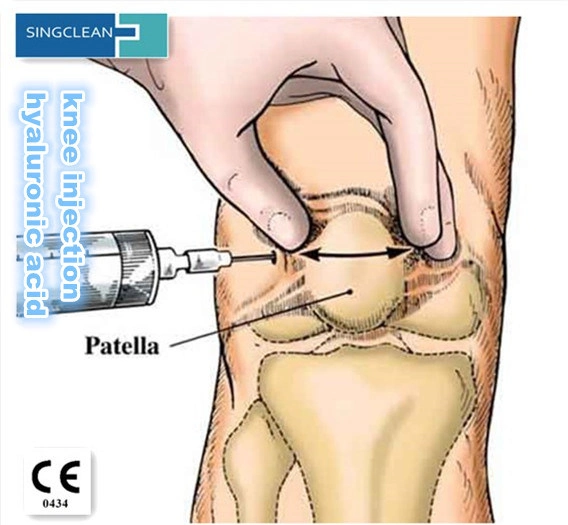 Terapia de hialuronato de sodio en Osteoartritis