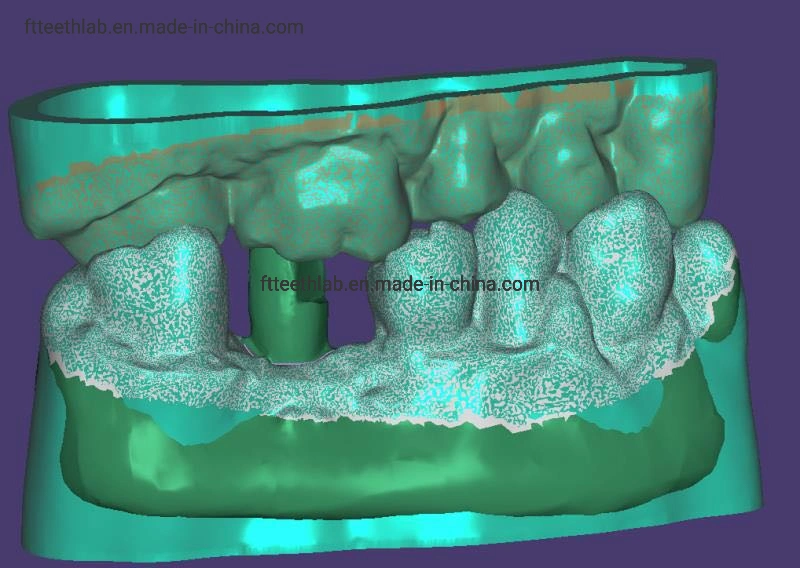 Мост полного арка, изготовлено с помощью файлов 3D-сканирования Dental Имплантаты