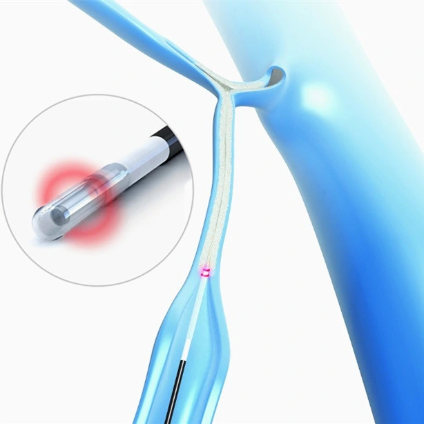 Prix de gros SMA 905 360 Fibre radiale Evlt Proctologie anorectale phlébologique Fibre nue 600 Um