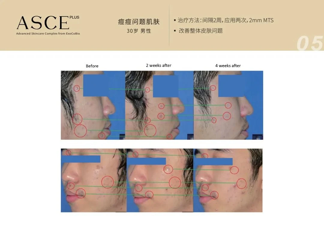 Freeze-Dried Exosome Solution Asce Plus Asce+ Exsome Human Stem Cell Derma Signal Kit Cfda Kfda Grow-Th Factor Skin Care Anti Aging Products Filler