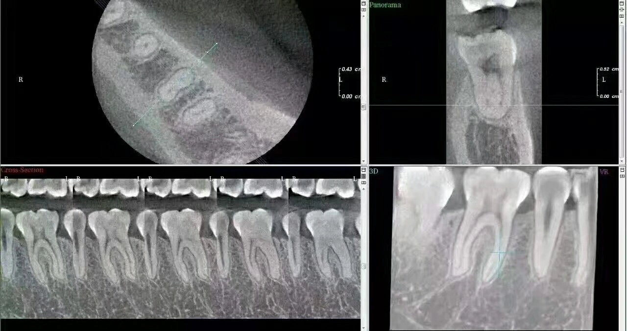 Cheap Price 3D Dental Cbct X Ray Machine with Ceph for Hospital Dental Clinic