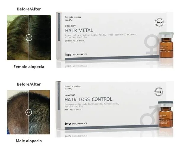 Inno TDS Vital Control de pérdidas de cabello calvicie de patrón masculino Tratamiento alopecia androgénica o mejorar la salud del cuero cabelludo reducir la pérdida del cabello promover el crecimiento El crecimiento de cabello nuevo