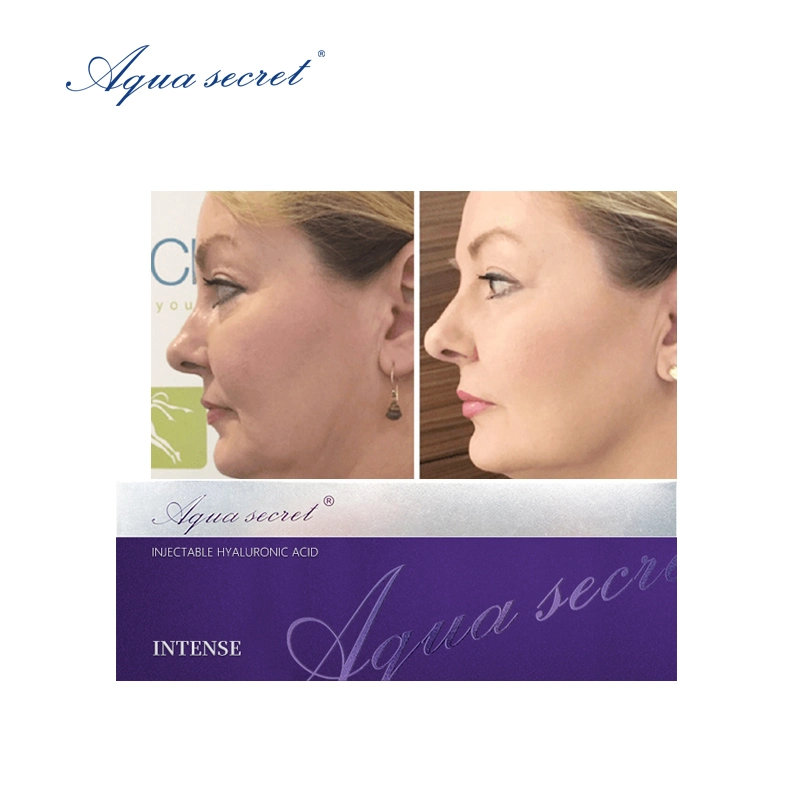 Make You Look So Young Dermal Filler Injectable Hyaluronic Acid