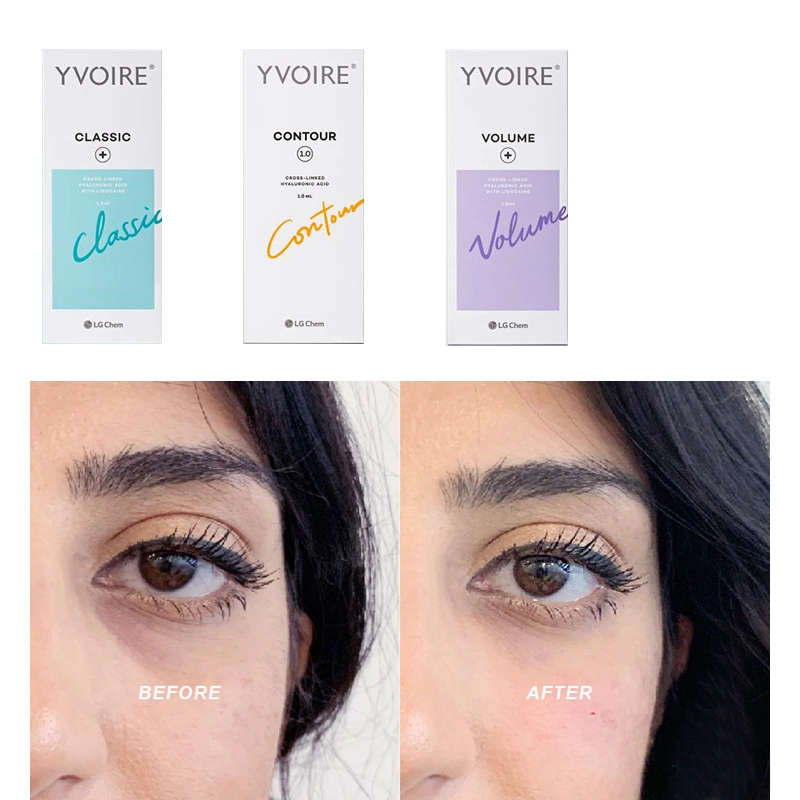 Yvoire Classic / Volume / Contour Injection Modified Sodium Hyaluronate Gel Hyaluronic Acid Dermal Filler Yvoire Neuramis Rejeunesse Dermal Filler