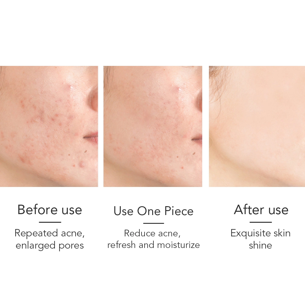 Reparación de la piel Control de aceite Anti acné piel aclaramiento de la cara cuerpo Jabón de blanqueamiento