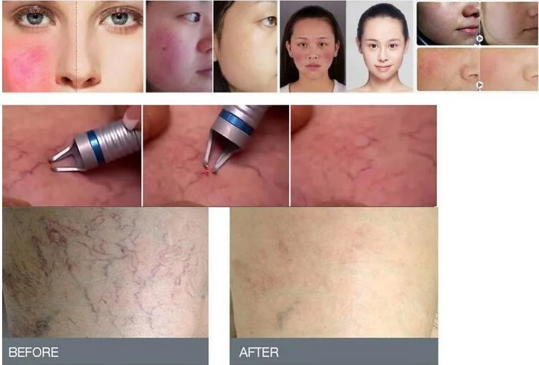 خصم 30% على الليزر 980nm Laser Machine Treatment Diode Laser Machine ممحاة آلة التلقيح ممحاة شفط الالتصاق وعائي ليزر عنكبوت إزالة الفريكوز الأوردة