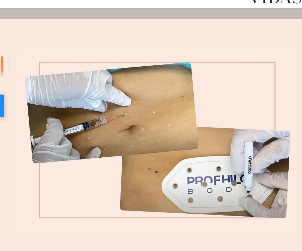 Profhilo for Body Profhilo Body Rejuvenates The Skin Without Adding Volume Like Other Types of Fillers. The Skin Is Actually Restored, Skin Sagging Is Addressed