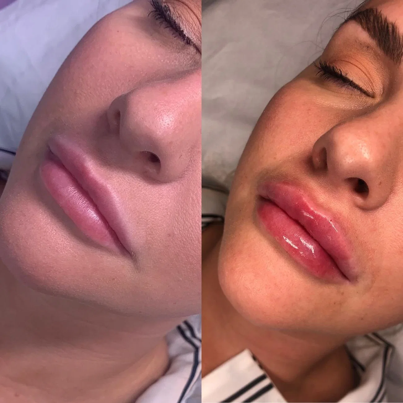 Kairax Fine Deep Sub-Q Hyaluronsäure Dermal Filler Plastische Chirurgie Implantate für Lippen, Nasolabialfalten Wangenverbesserung Cross Linked Hyaluronsäure