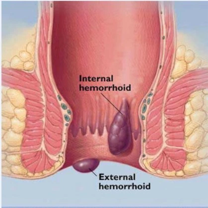 980+1470nm Diode Soft Tissue Cutting Hemorrhoids Removal Laser