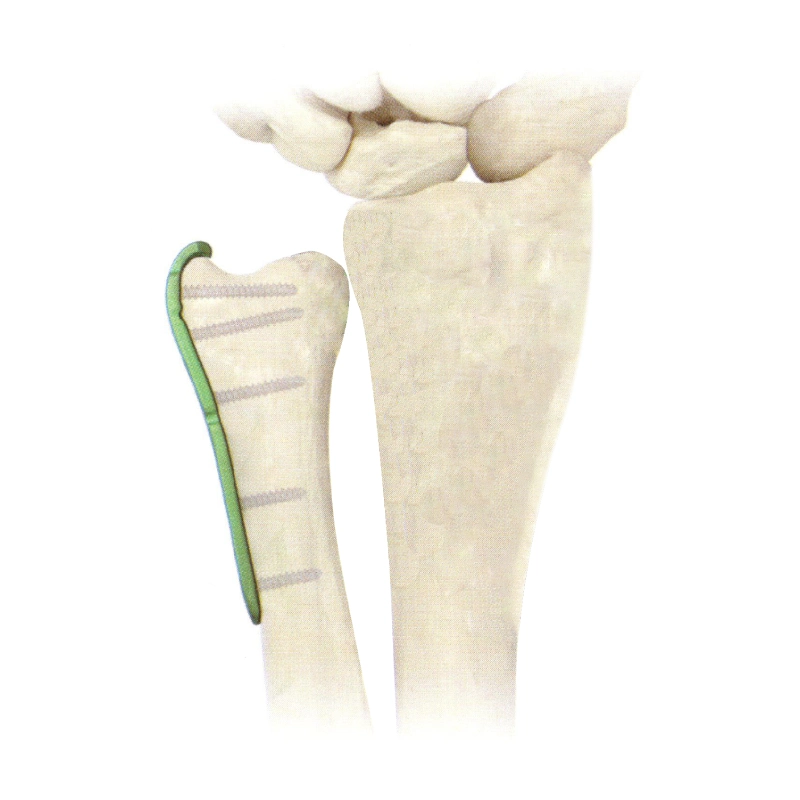 Distal Ulna Locking Plate, Surgical Product