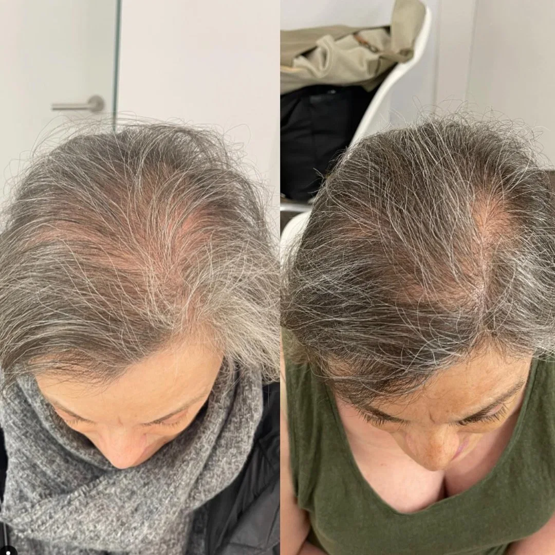 Haut de page coréen ASCE+ Hrlv Srlv exosomes lyophilisés pour la restauration des cheveux Soin du cuir chevelu anti perte de cheveux manière naturelle d'améliorer votre Santé des cheveux